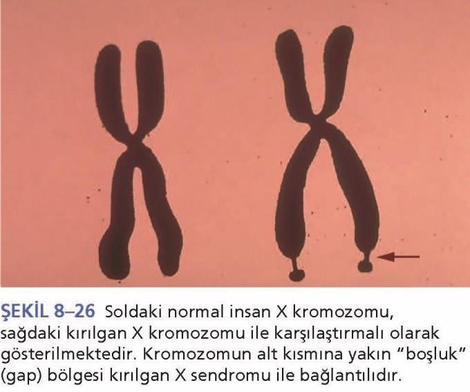 4.4.2 Kırılgan X Sendromu (Martin-Bell Sendromu) X kromozomunda folat-hassas bölge taşıyan bireylerde kırılgan X sendromu (Martin-Bell Sendromu) görülür.