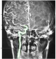 Karotis arter arteriogramını inceleyebilirsiniz.