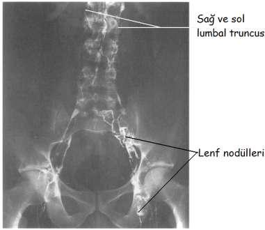 Ductus lymphaticus dexter: (sağ lenf kanalı) YaklaĢık 1 cm uzunluğunda olan sağ lenf kanalı truncus jugularis dexter, truncus subclavius dexter ve truncus bronchomediastinalis dexterin birleģmesi ile