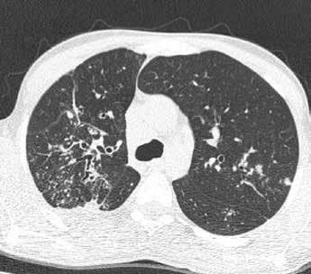 BÖLÜM 23 Akciğer Tüberkülozunda YÇBT 235 Konsolidasyon: Alveollerin sıvı, inflamasyon ya da hücreyle dolması sonucunda oluşan, genellikle düzensiz sınırlı, arka planda damarların seçilemediği,