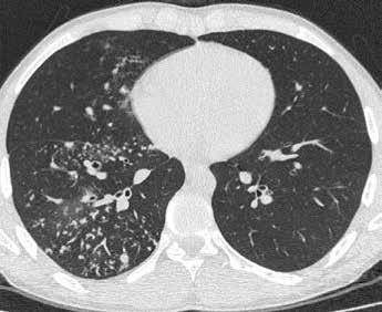 BÖLÜM 23 Akciğer Tüberkülozunda YÇBT 239 Resim 4: Kalp düzeyinden geçen toraks YÇBT kesitinde, sağ akciğer alt lob bazal segmentlerde tomurcuklu ağaç görünümleri izlenmektedir.