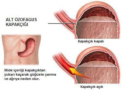 normalde karın boşluğu içinde bulunan mide-yemek borusu bileşkesi, bu