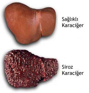 Karaciğer Hastalıkları Hepatit ; temel olarak karaciğer hücrelerinin hasarına sebep olan inflamatuar bir hastalıktır.