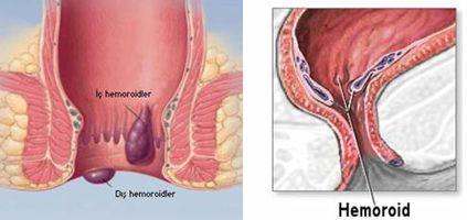 Anal hastalıklar Hemoroidler ; anal