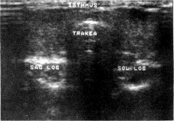 Tiroid Bezi Ultrasonografisi Munci ORAN* Nuvit ŞENER** Fahrettin HASIRCIOĞLU** Ömer BEYKAL** Salih GÜRAN** TahsinR.
