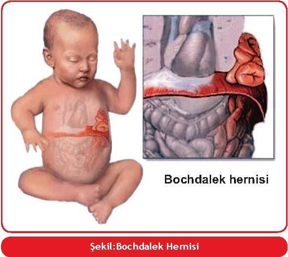 Diafragmatik Herni Prof. Dr. E.