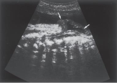 Fetal Spina Bifida: Tanı ve Yaklaşım Prof. Dr. E.