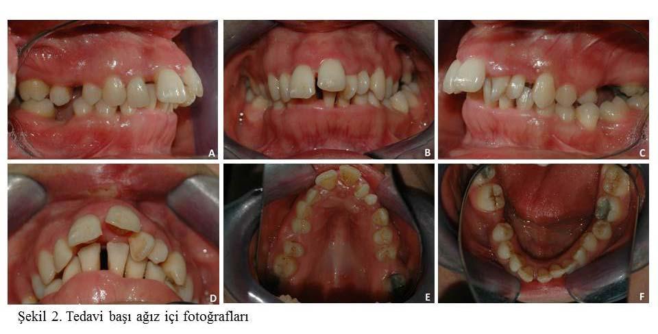 mukozada irritasyonlar izlenmiştir (Şekil 2. D). Sefalometrik değerlendirmede (Şekil 3.
