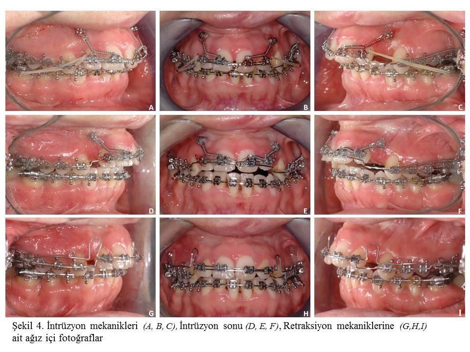 SINIF II,1 DERİN KAPANIŞ TEDAVİSİ 57 Bununla birlikte intrüzyon sırasında oluşabilecek kesici protrüzyonu ihtimaline karşın anterior segment sağ-sol 70 er gram yatay ve Sınıf II elastiklerle