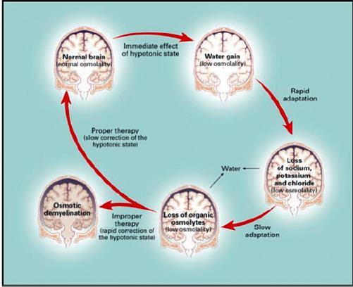 Hiponatremi Tedavisi Kronik Hiponatremi Hızlı