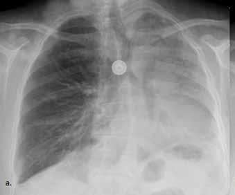GİRİŞ Pulmoner hamartomlar akciğerin nadir görülen benign tümörlerindendir. Nadiren malign transformasyon gösterirler.