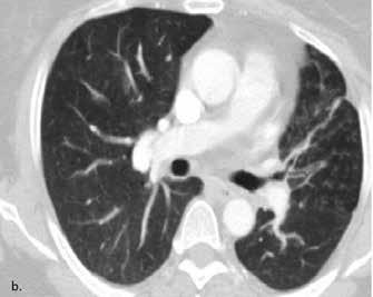 Nefes darlığı şikâyetleri tamamen gerileyen hastanın, SFT değerlerinde FEV 1 değeri preoperatif 0.96 lt (%62) den 1.