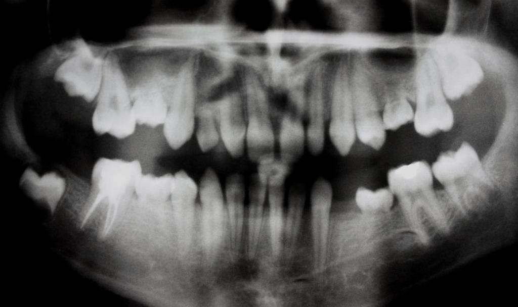 Böyle dişler normal oklüzal seviyenin