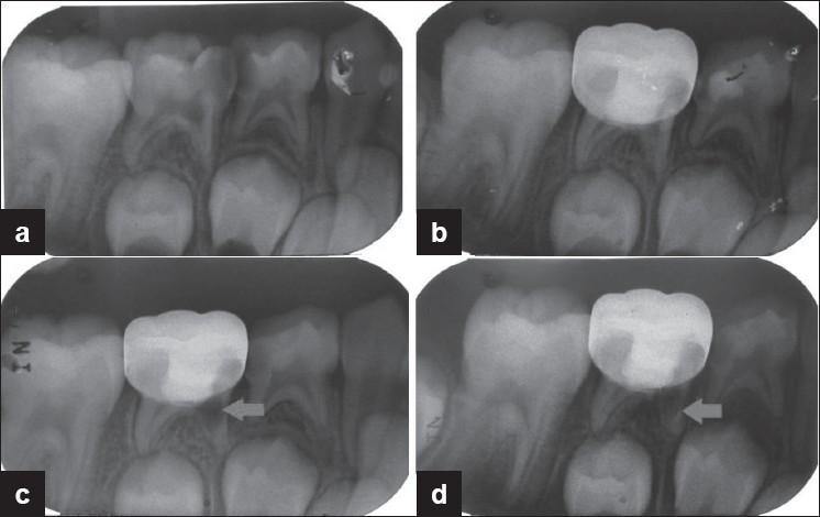 8-Süt dişlerinin diğer patolojik rezorpsiyonları: Fizyolojik veya patolojik rezorpsiyonlar dışında idiopatik