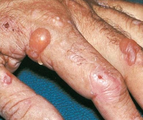 HCV ve Dermatolojik Bulgular Porphyria cutanea tarda HCV ile enfekte kişilerde görülme sıklığı; 0.77-1 Normal popülasyondan 12 kat fazla Porfiryalı hastalarda HCV enfeksiyonu görülme sıklığı %40-50.