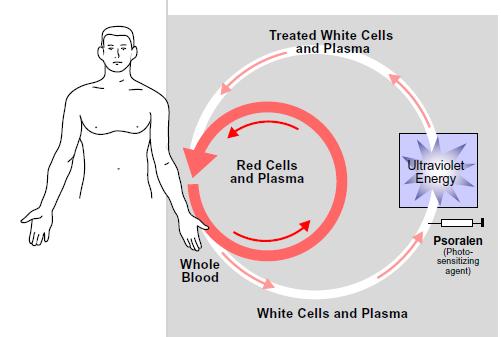 Fotoferez Basit olarak psöralen ile etkileşime girmiş periferik kan mononükleer hücrelerinin ultraviyole-a (UVA) ile ışınlanmasıdır.