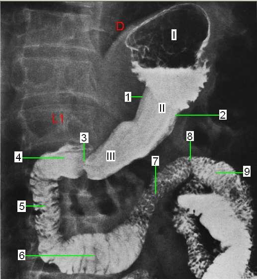 Mide duodenum radyogramında anatomik yapıyı gösteriniz.