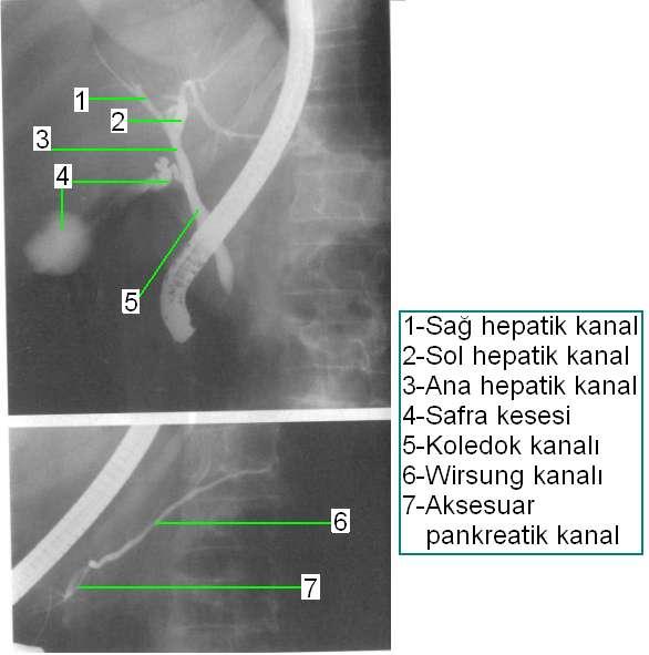 ERCP de (endoskopik Retrograd kolanjiopankreatografi) anatomik yapı Endoskop ve X-Ray ıģınlarının kombine olarak kullanımıyla kontrast madde verilerek