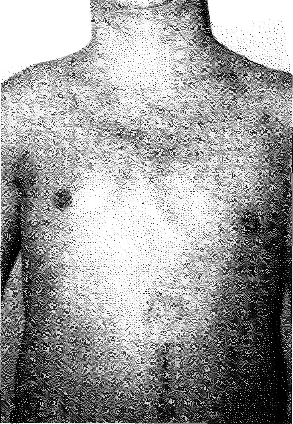 Jasonni V, Zelli-Cbiesa PL, Repetto P, Torre M, Mobİli F, Mazzalo C, Martİciello G: Congenital deformities of the chest walb Surgical treatment. Minerva Pediatr Sep.49(9):407-13,1997 3.