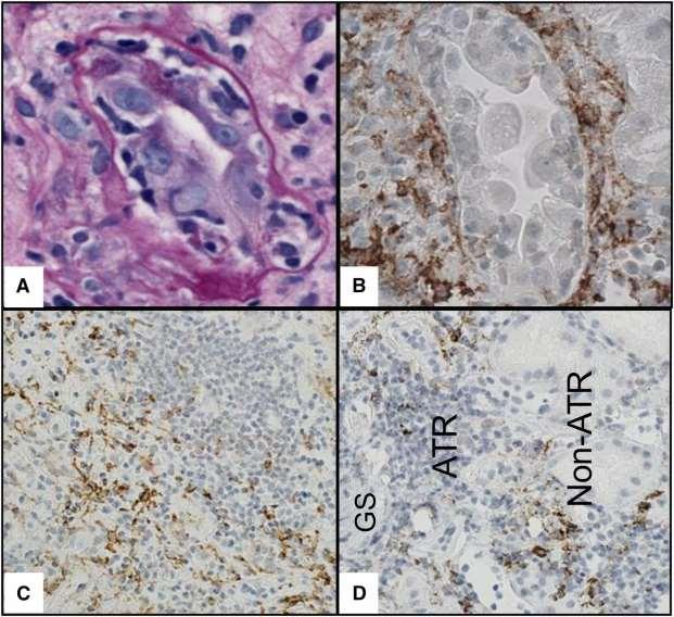 Representative images of the association of DC-SIGN+ cells with allograft inflammation and