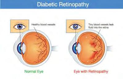 Retinopati Eritropoetin tedavisi ile aneminin düzeltilmesi maküla ödeminin azalmasına ve retinadaki sert eksüdaların