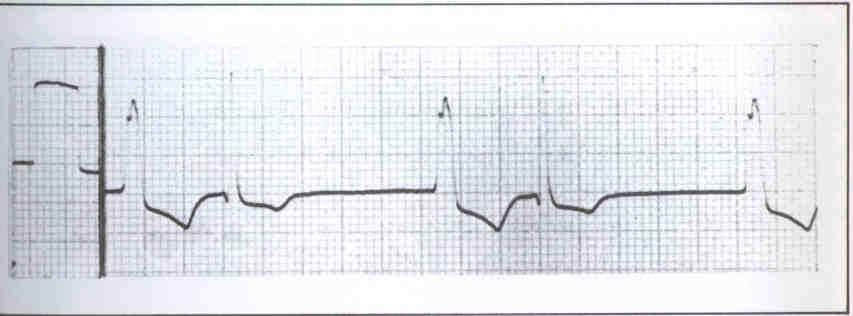 -EKG de ST depresyonu, PR uzaması, aritmi, kalp bloğu, ventriküler fibrilasyon