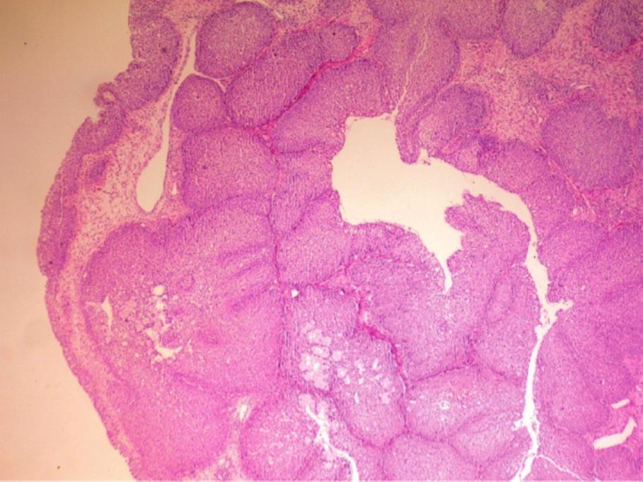 Karataş et al. RESİM 6: Stroma içerisinde invajine olmuş skuamöz epitel yuvaları HE (hematoksilen eozin) x40. şeklinde görülmektedir. Kitlenin yerleşimi doğru tanı için önemli ipuçlarından biridir.