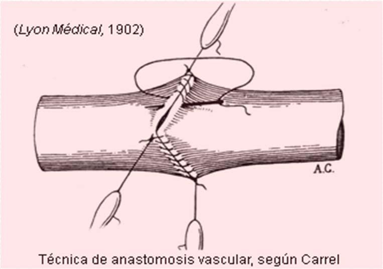 Anastomose bout a bout de la jugulaire et de la carotide primitive.