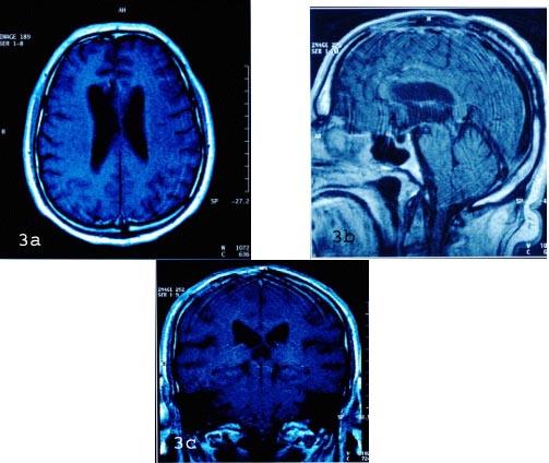 Resim 3a,3b,3c: Kontrol MRI da postoperatif değişiklikler görülmekte, nüks ya da rezidü tümör