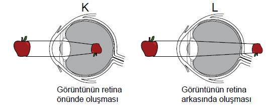 Bu göz kusurları ile ilgili, I. K göz kusuru kalın kenarlı mercek ile tedavi edilir. II. L göz kusuru hipermetrop olarak adlandırılır. III.