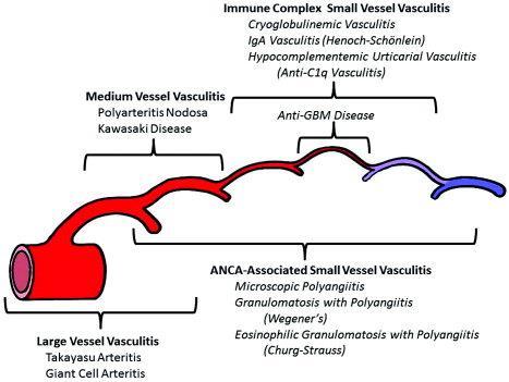 ANCA ilişkili hızlı ilerleyen glomerulonefrit (Wegener Granülomatozu) Hızlı ilerleyen glomerulonefritlerden birisi Böbrek fonksiyon bozukluğu Akciğer