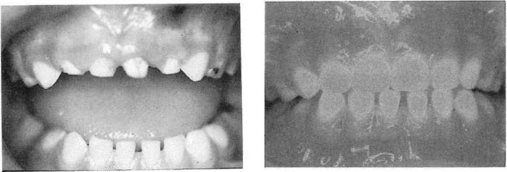 Üst süt ön keser ve yan keser dişlerde aşın madde kaybı. Resim 4.
