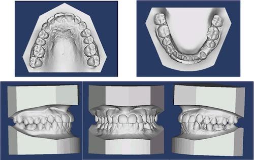 DİŞ HAREKETİYLE KEMİK DOKUSUNUN ŞEKİLLENDİRİLMESİ 57 Resim 6: Tedavi sonu dental model fotoğrafları.