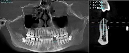58 ÖZER ALKAN-YEŞİM KAYA-BETÜL YÜZBAŞIOĞLU Resim 8: Tedavi başı ve sonu lateral sefalometrik radyografilerin