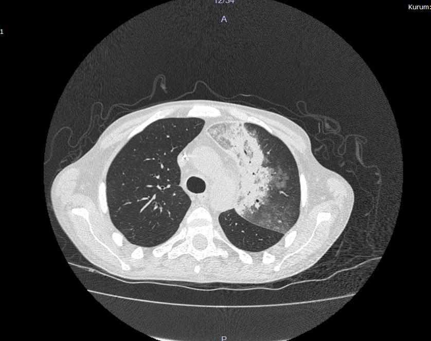 Torax HRCT; Akciğer parankim alanlarının değerlendirilmesinde; sol akciğer üst lobda