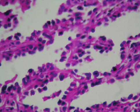 Skuamöz hücreli karsinom, adenokarsinoma göre daha az heterojendir. 2015 DSÖ sınıflamasında keratinize, nonkeratinize ve bazaloid olmak üzere üç subtipe ayrılır (30).