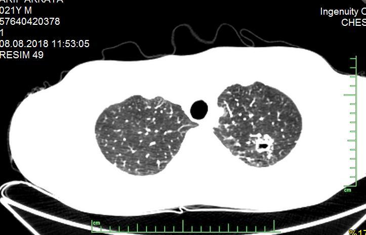 5.6.2018 toraks BT de kavite Arb (+) anti-tb tedavi 45 gün sonra kültürde atipik mikobakteri üremesi Olgu (M.Szulgai).