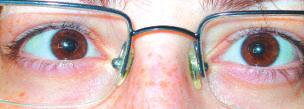 Genç eriflkin hastada gözlük takmak istemedi- i durumlarda bifokal kontakt lensle