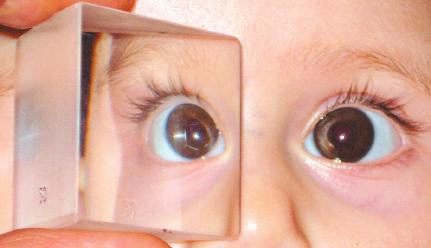 Görme düzeyi yeterli olmayan hastalarda prizma ile her iki gözün korneadan fl k yans mas simetrik hale getirilerek ölçüm elde edilebilir (Krimsky testi).