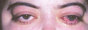 11-67 Graves hastal n taklit eden infantil fibroblastik tümör nedeniyle çocukta sol gözde ileri derecede restriktif flafl l k ve proptozis izleniyor.