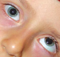 bafllayan pigmenter retinopati, kalpte ileti anomalileri, diabetes mellitus,