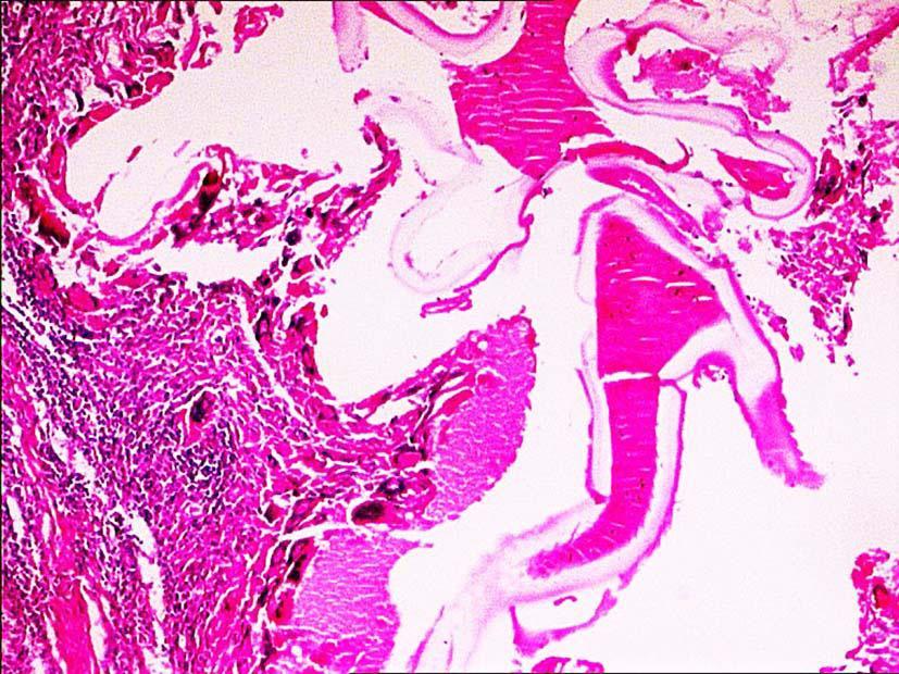 Laminar layer PAS positive, liver, X10 Bu vakada mikroskobik bakısı yapılan karaciğer kist sıvısı ve germinal membranında protoskolekslere rastlanılamamıştır.