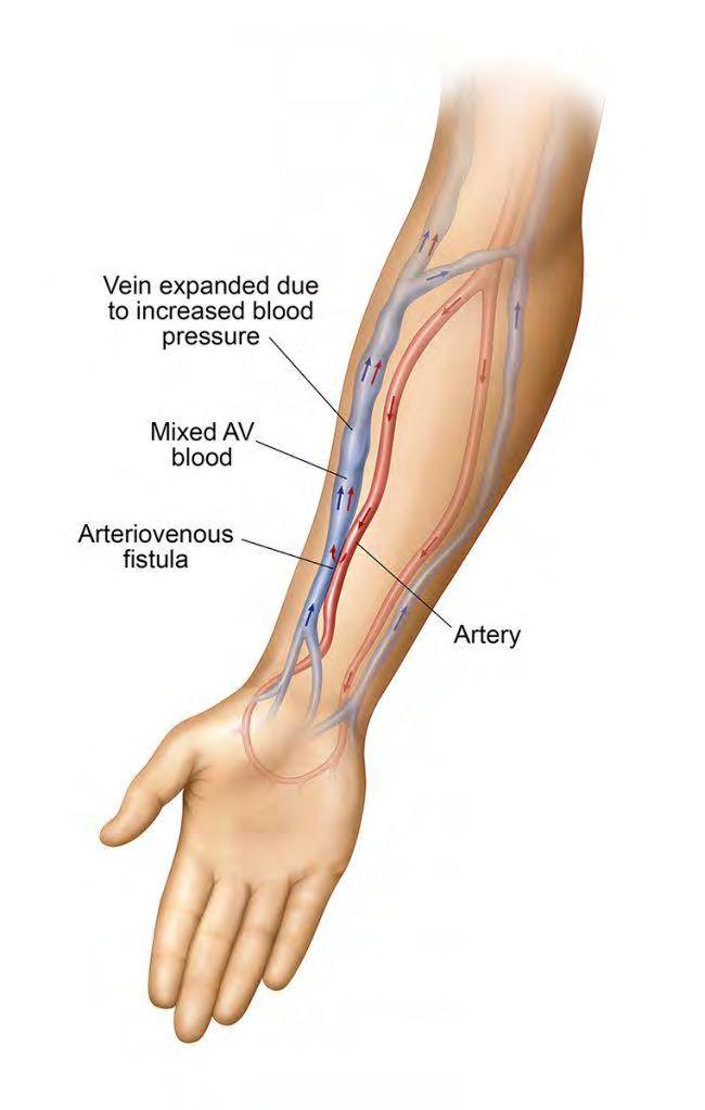 ARTERİOVENÖZ FİSTÜL Başarılı AV fistül için gerekenler Diyalizi desteklemeye yetecek kadar kan akımı Tekrarlayan kanülasyona izin verecek kadar olgunlaşma Deri yüzeyinden itibaren 1 cm derinlik (0.