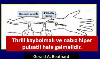 AVF DE GÖRÜLEN KOMPLİKASYONLAR ERKEN/GEÇ YETMEZLİK MATURASYONU NASIL DEĞERLENDİRECEĞİZ? AUGMENTASYON TESTİ: İnflow stenoz değerlendirmesinde yapılan bir muayenedir.