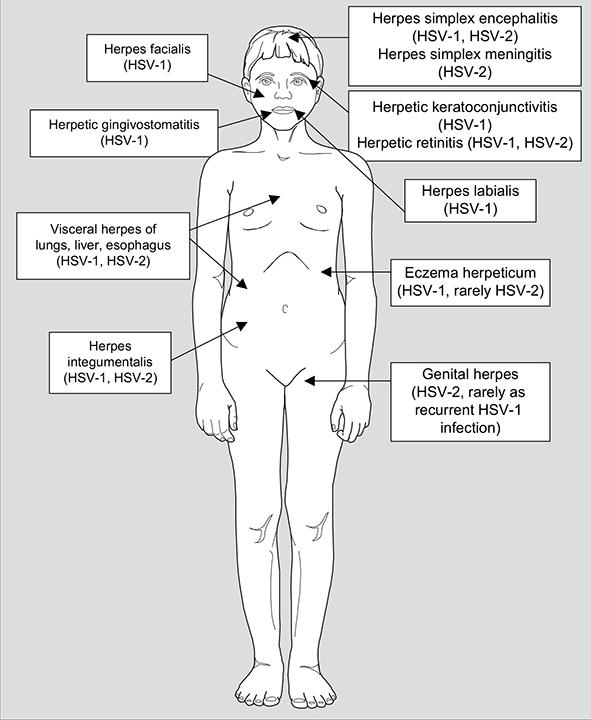 HSV-1/2 bağışıklığı baskılanmışlarda (özellikle hücre aracılı) inatçı mukokutanöz lezyonların yanı sıra özofajit, hepatit, pnömoni, meningoensfealit gibi dissemine viseral infeksiyonara da