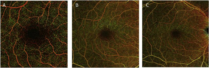 OKTA DA normal bir kişide değişik boyutlardaki kesitlerle Retinal damarların görünümü (A) 3A 3mm (B) 6A 6mm (C) 8A 8 mm.