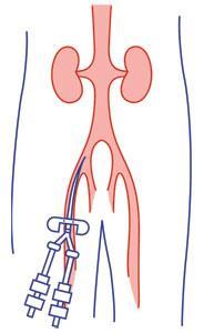Damar yolu sağlanması Acil durumda femoral kateter Girişim kolaylığı Sitratın direk