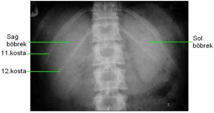 9: Direkt üriner sistem (DÜS) radyogramı Ġntravenöz Pyelografide Anatomik Yapı Ġntravenöz pyelografi, intravenöz yolla dolaģıma