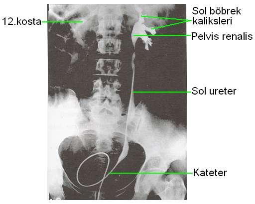 (Retrograd Ürografi)Anatomik Yapı Sistoskopi ile üreterlere sokulan