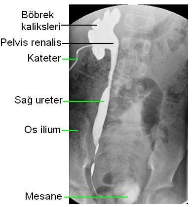 Antegrad Pyelografide (Antegrad Ürografi) Anatomik Yapı Renal pelvis ve